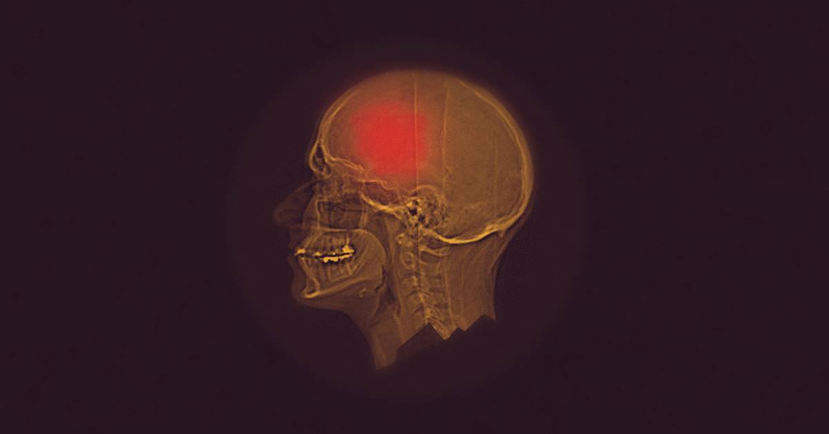 X-ray image of skull with head injury