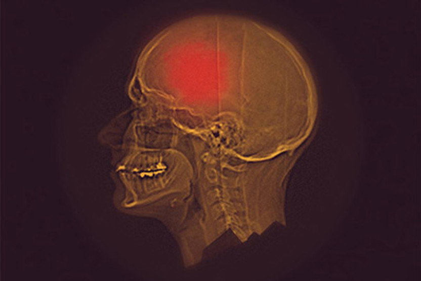 HEAD INJURIES xray image